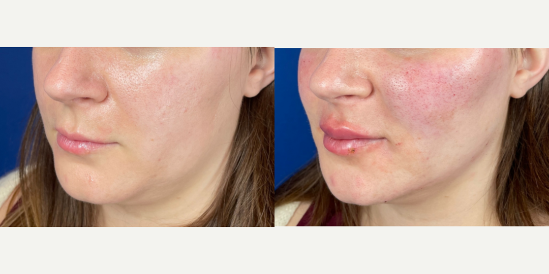 Lip-Fillers-before-4900524-after-4900525-1-11439714.webp