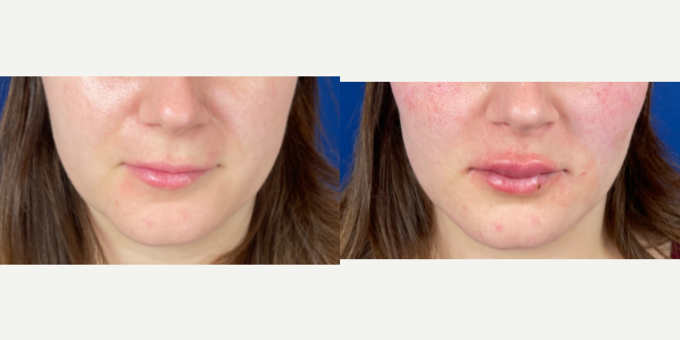 Lip-Fillers-before-4900533-after-4900534-1-11439718.webp