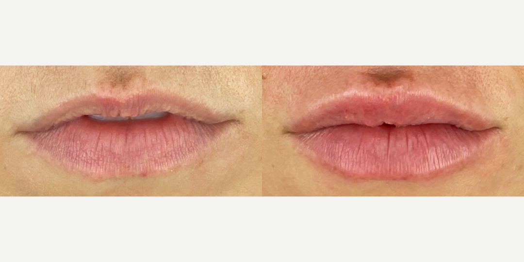Lip-Fillers-before-4950562-after-4950563-1-11592340.webp