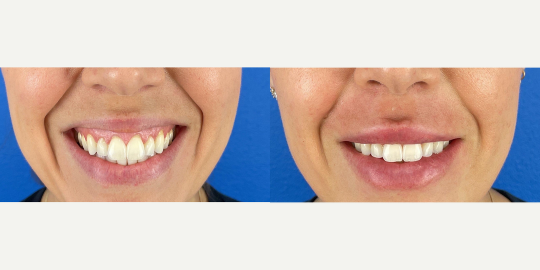 Lip-Fillers-before-4950564-after-4950565-1-11592344.webp