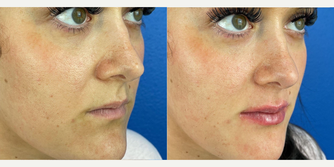 Lip-Fillers-before-5022718-after-5022719-0-11771173.webp
