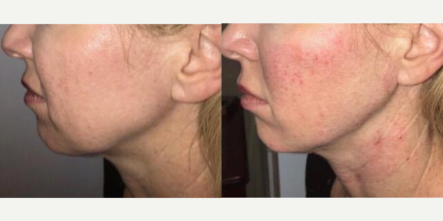 Dermal-Fillers-before-3708098-after-3708099-1-7656684.webp