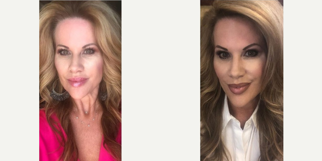Dermal-Fillers-before-3788776-after-3788777-1-7916305.webp