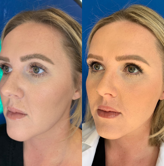 Dermal-Fillers-before-4451018-after-4451019-1-9793804.webp