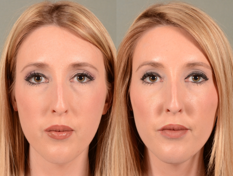 Dermal-Fillers-before-4196332-after-4196333-2-6577576.webp