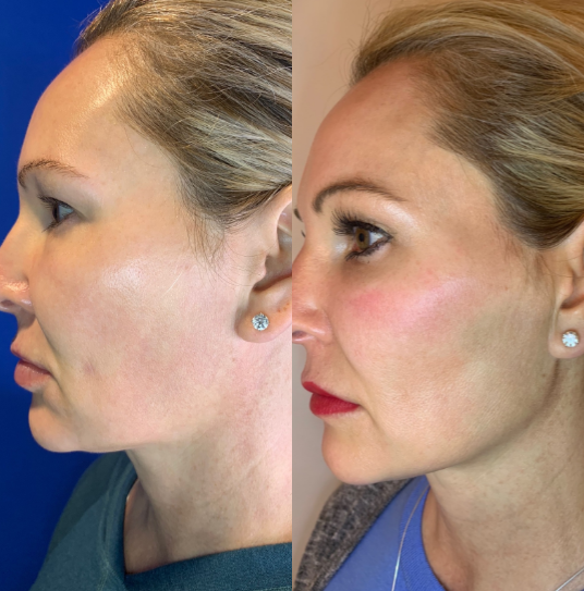 Dermal-Fillers-before-4451023-after-4451024-1-9793831.webp
