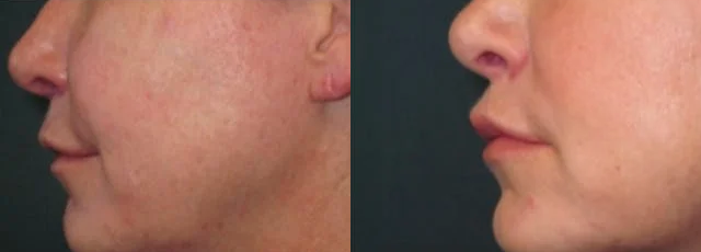  Lip lift 