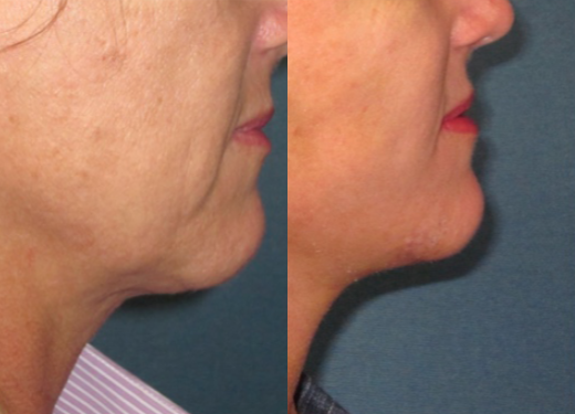  Natural appearing lower face/neck lift 