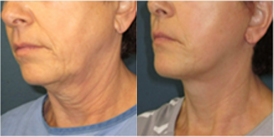  Lower Face and Neck Lift 