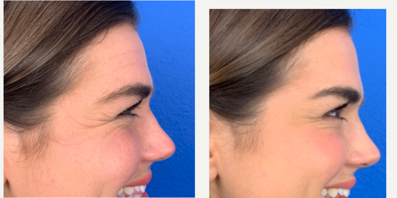 Xeomin-before-4900547-after-4900548-1-11439745.png