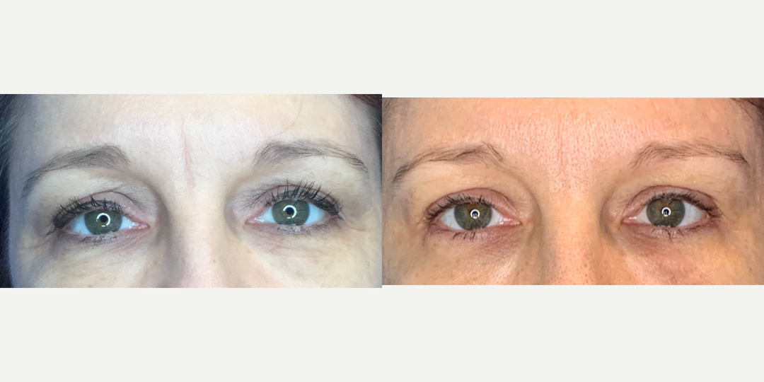  45-54 year old woman treated with Xeomin to crows feet and glabellar, shown 2 weeks post op. 