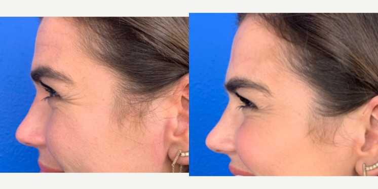Xeomin-before-4900544-after-4900545-1-11439743.png