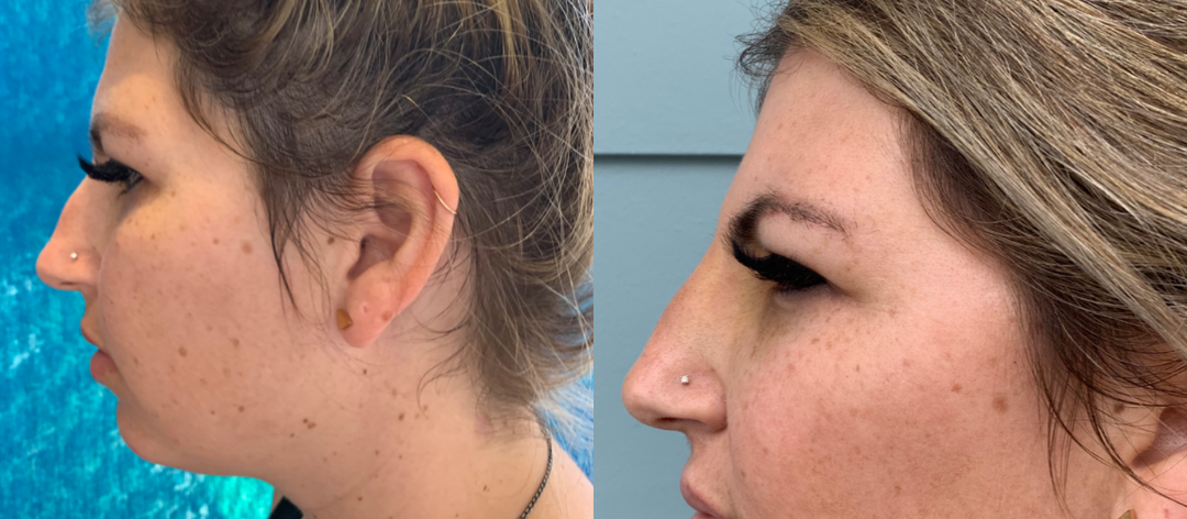 Nonsurgical-Nose-Job-before-4049275-after-4049276-2-8660513.png