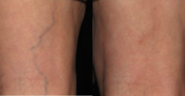 Sclerotherapy-before-4361789-after-4361790-2-5030857.png