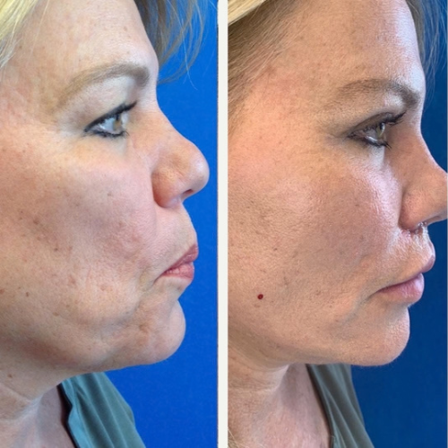 Facelift-before-4640193-after-4640194-1-10508380.png