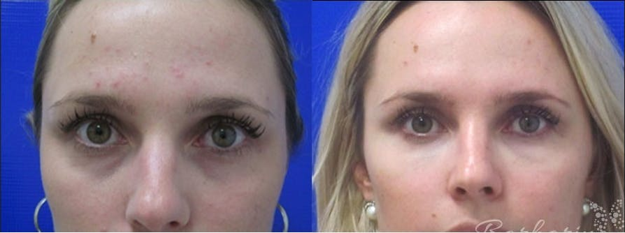 Liquid-Facelift-before-4201272-after-4201273-1-9207784.png