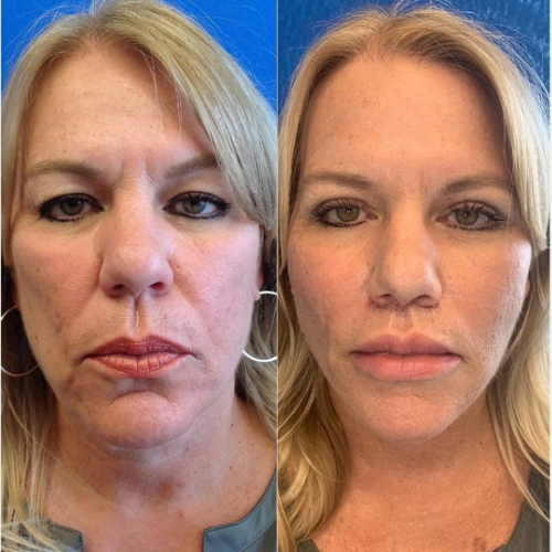 Facelift-before-4640197-after-4640198-1-10508355.png