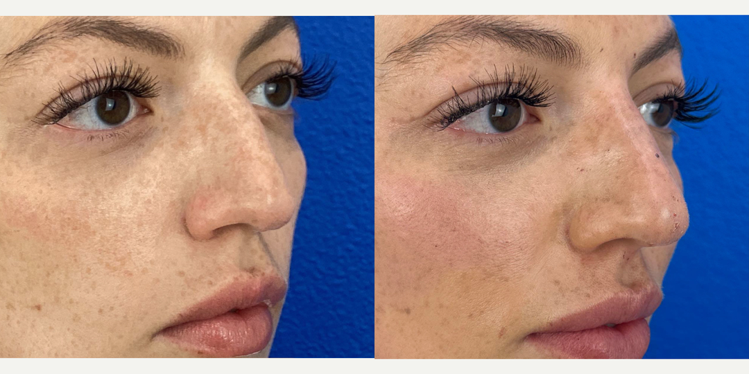 Nonsurgical-Nose-Job-before-5654435-after-5654436-1-12780665.png