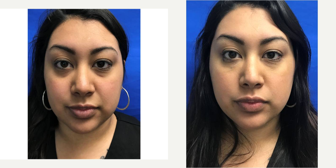 Nonsurgical-Facelift-before-3449496-after-3449497-1-6628024.png