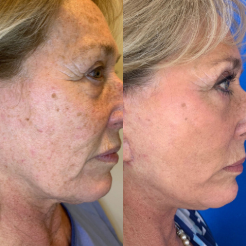 Facelift-before-4440743-after-4440744-1-9760619.png