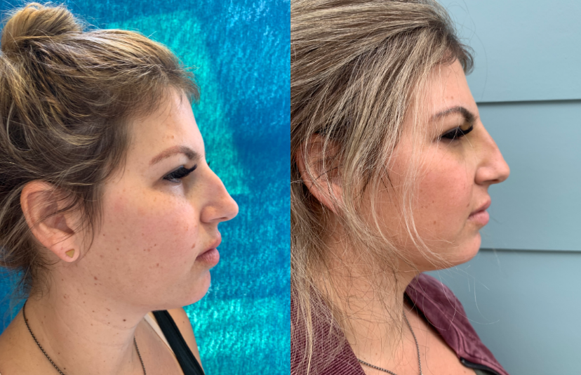 Nonsurgical-Nose-Job-before-4049281-after-4049282-2-8660511.png