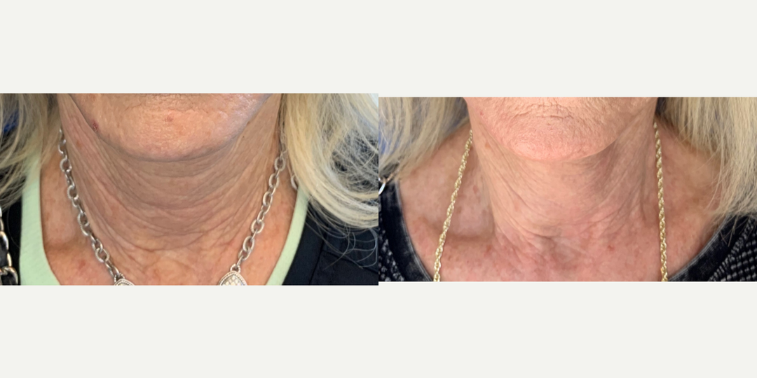 Nonsurgical-Neck-Lift-before-4801272-after-4801273-1-11105394.png