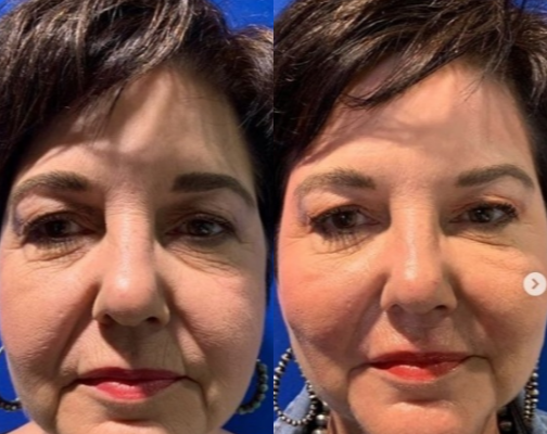 Liquid-Facelift-before-4099844-after-4099845-1-8918028.png