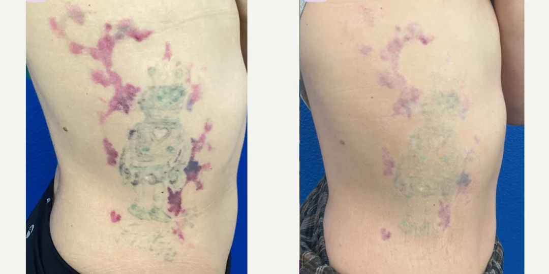 Tattoo-Removal-before-8600310-after-8600311-1-14088495.png