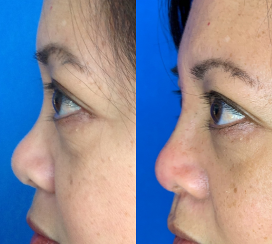 Nonsurgical-Nose-Job-before-4451000-after-4451001-1-9793021.png