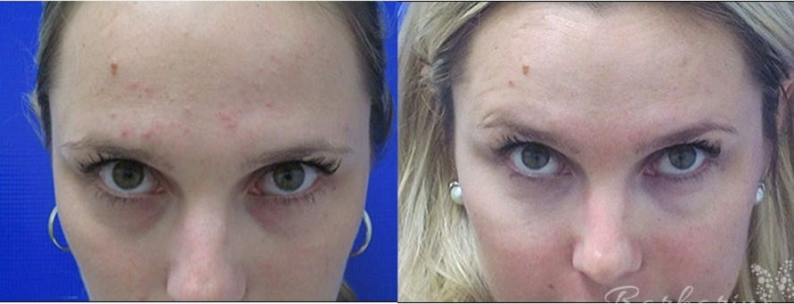 Liquid-Facelift-before-4201269-after-4201270-1-9207783.png