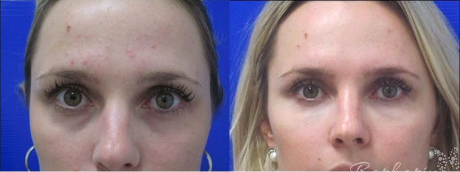 Radiesse-before-4201282-after-4201283-1-9207789.png