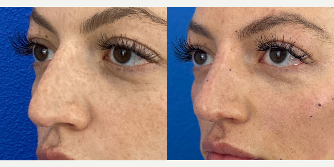 Nonsurgical-Nose-Job-before-5654459-after-5654460-1-12780666.png