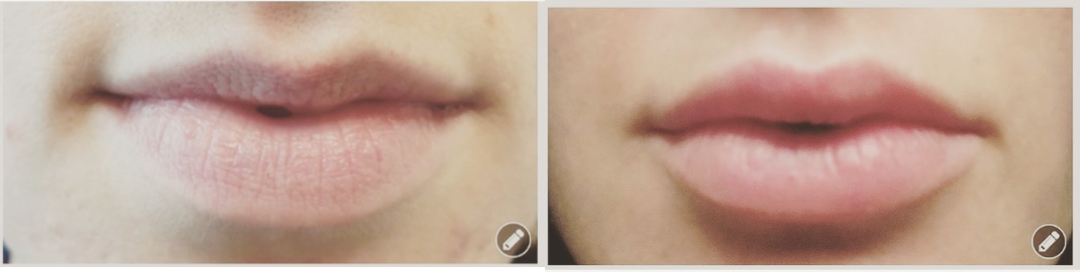 Radiesse-before-3877191-after-3877192-1-8181854.png