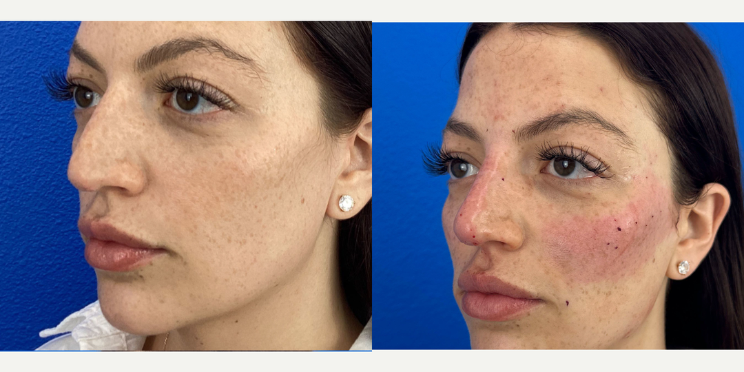Nonsurgical-Nose-Job-before-5654461-after-5654462-1-12780667.png