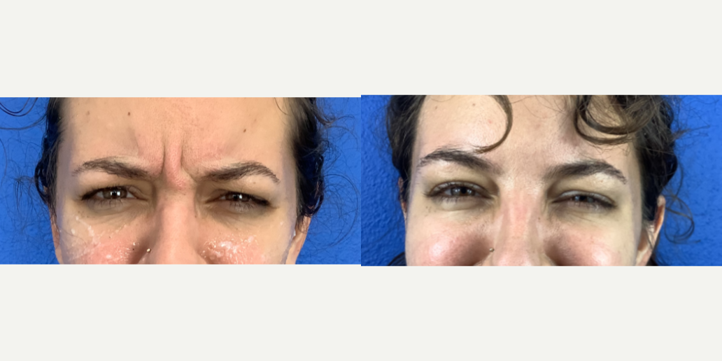 Xeomin-before-4900522-after-4900523-1-11439728.png