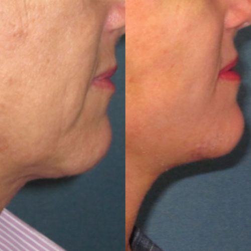Lower-Facelift-before-4196352-after-4196353-2-8199125.png
