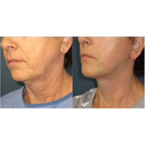 Lower-Facelift-before-3107935-after-3107936-1-5200606.png