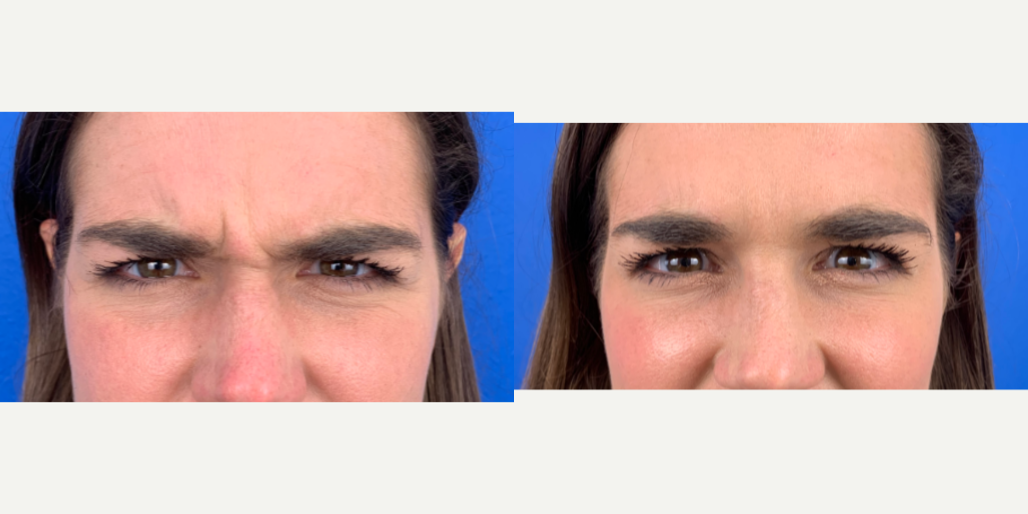 Xeomin-before-4900537-after-4900538-1-11439736.png