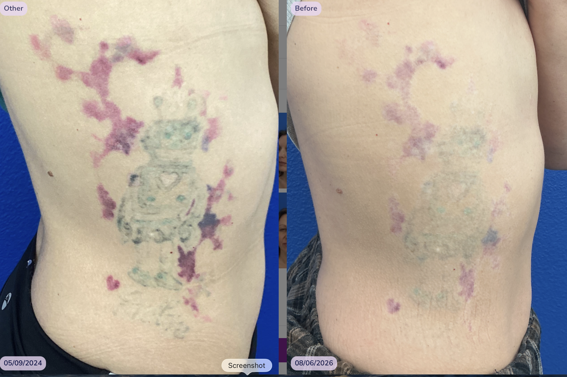 Medspa in Austin, TX, 78746  Tattoo Removal Near Me