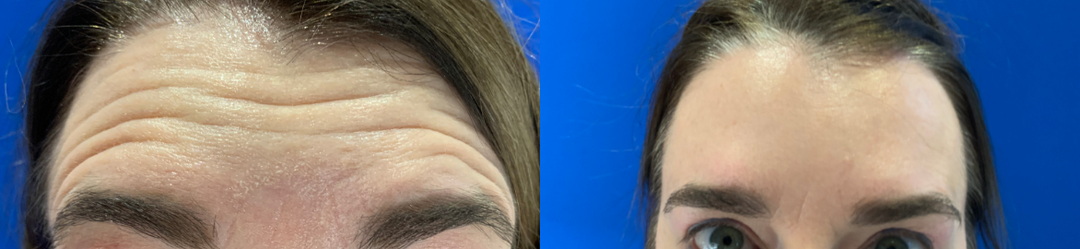 Xeomin-before-4006282-after-4006283-1-8530790.png