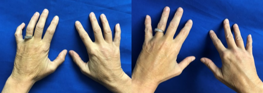 Hand-Rejuvenation-before-4480646-after-4480647-2-9853664 (1).png