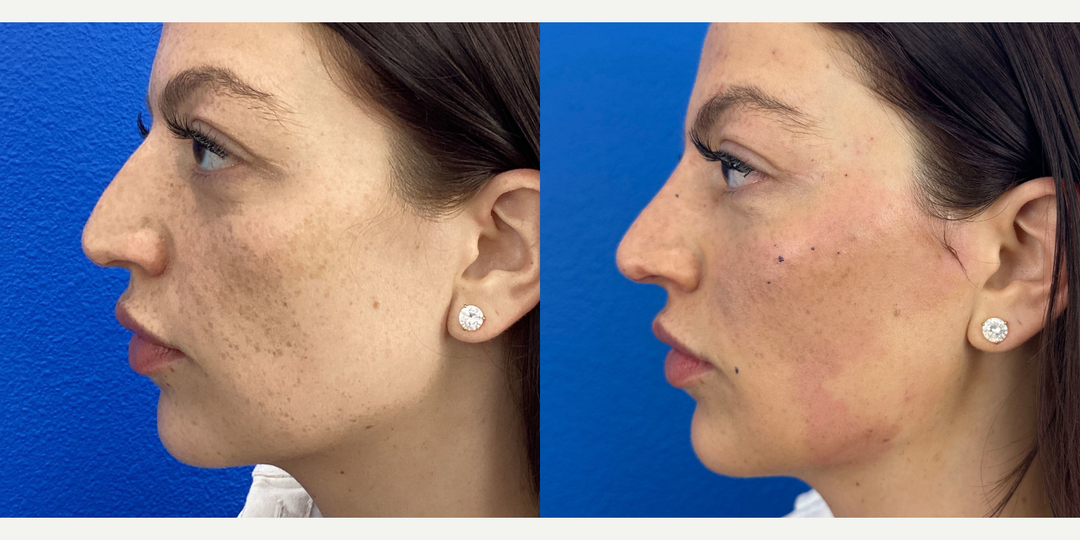 Nonsurgical-Nose-Job-before-5654181-after-5654182-1-12780668.png