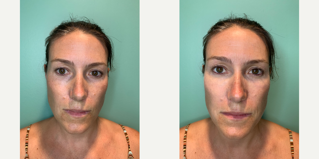 Ultherapy-before-4577049-after-4577050-1-10195270.png