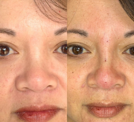 Nonsurgical-Nose-Job-before-4451002-after-4451003-1-9793037.png
