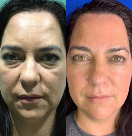 Liquid-Facelift-before-4451066-after-4451067-1-9793841.png