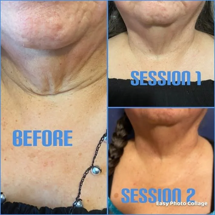 Double Chin Treatment