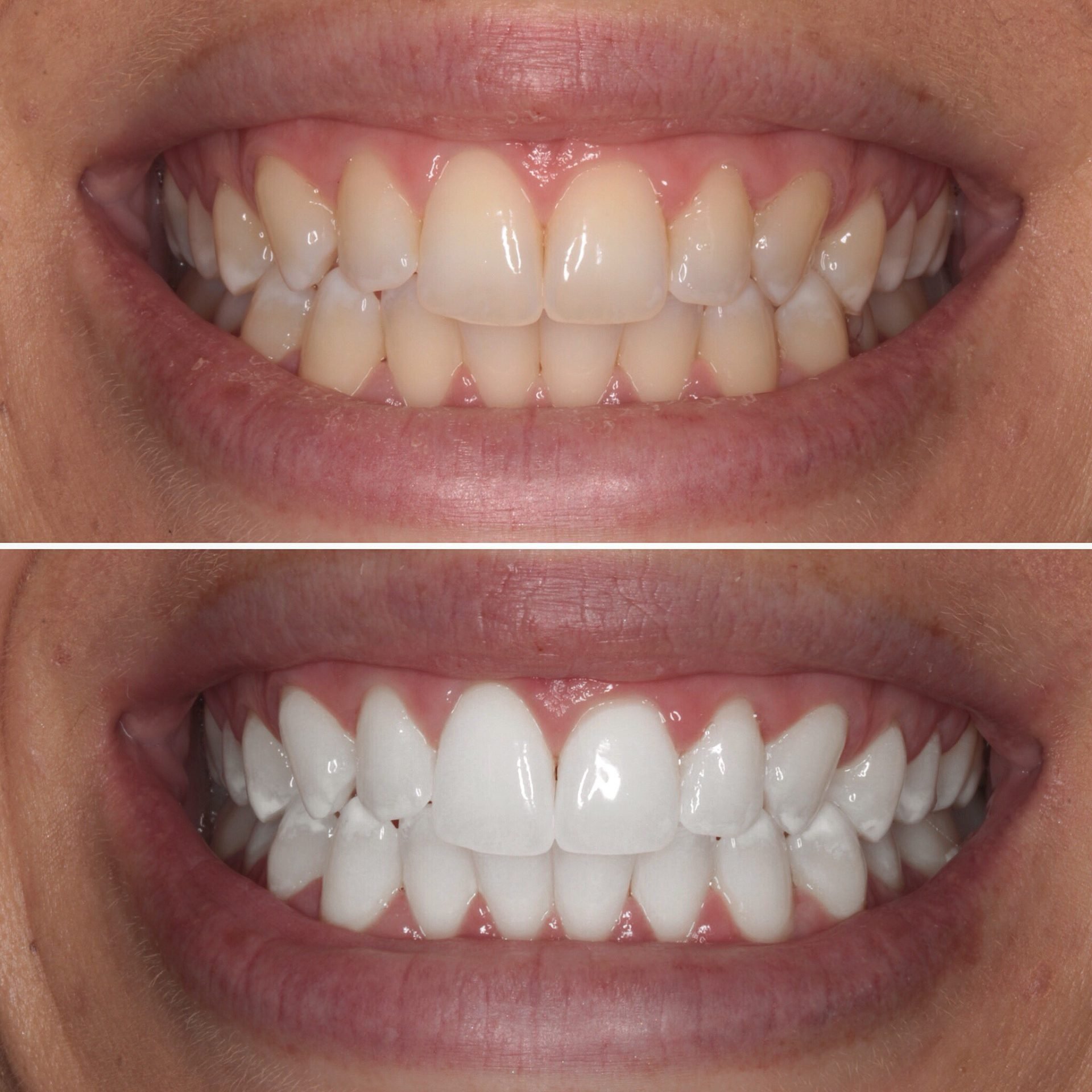 1 Hour Teeth Whitening