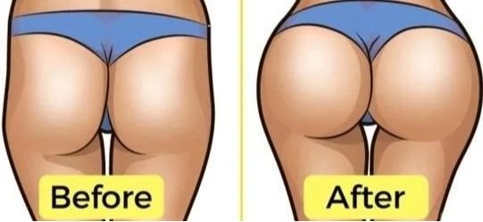 Glute Lift Treatment
