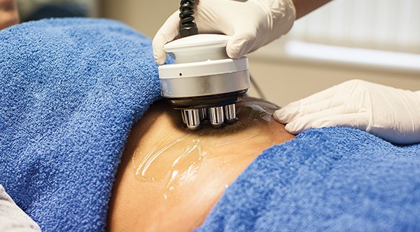 RF Skin Tightening