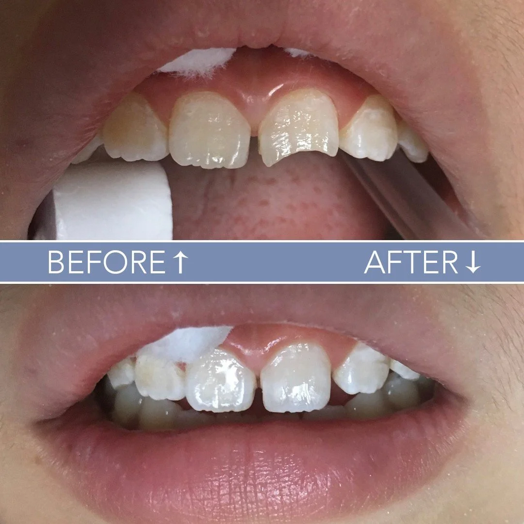 Urgent dental issue? 🚑  Don't wait! Reach out to Dr. Varchetto, your trusted emergency dentist, and let us provide the care you need promptly. Your dental health and comfort are our top priorities. Call us today to schedule your emergency appointmen